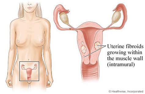 Kebiasaannya, sakit perut bahagian bawah untuk wanita adalah penyakit berkaitan organ reproduktif seperti rahim, ovari, pangkal rahim, faraj dan tiub fallopian. 14 Punca Sakit Dibawah Perut Diatas Kemaluan (2021 ...