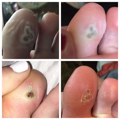 They appear to be disfigured and sore and appear to be small black spots in the early stages. Stages Of Plantar Wart Removal Using Salicylic Acid ...