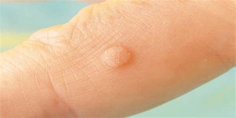 It can look like a solid blister or a small cauliflower. 7 Magical ways to kiss the warts away at home | Natural ...
