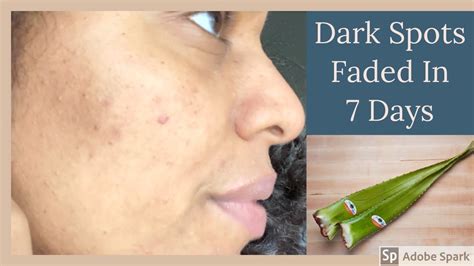 This started several years ago and despite my efforts, it has only gotten worse. Aloe Vera Gel Faded My Dark Spots| Homemade Skincare ...