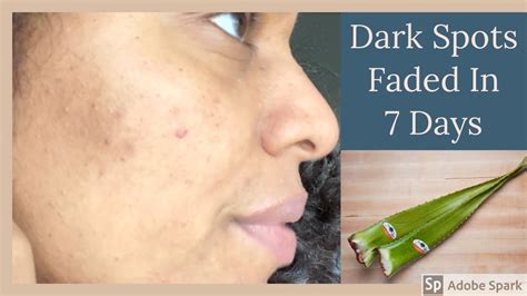 Department of agriculture plant hardiness zones 8 through 11. Aloe Vera Gel Faded My Dark Spots| Homemade Skincare ...