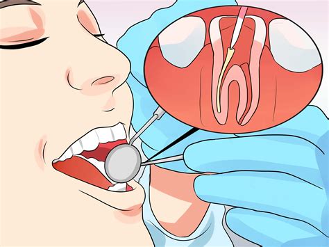 Here we will discuss about root canal and the pain left after this dental procedure. How to Stop Root Canal Pain (with Pictures) - wikiHow