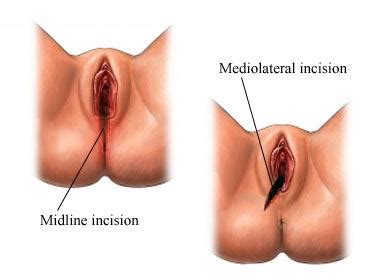 When to start yoga after normal delivery. Episiotomy Overview | FoundHealth