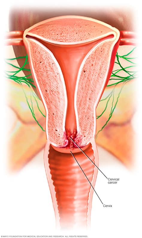 Learn more about cervical cancer: Cervical cancer - Symptoms and causes - Mayo Clinic
