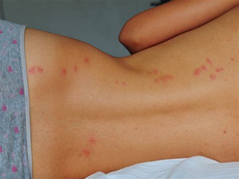 It may be a few this may not make the bites heal quicker, but it will stop them from feeling so irritated. Do Bed Bugs Really Bite? - Go Harvey Norman
