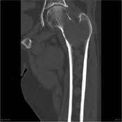 It accounts for approximately 10% of all. Multiple myeloma | Radiology Reference Article ...