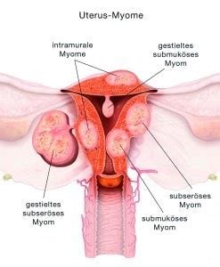 Es kann viele gründe haben, aber ich vermute, dass man vllt übertrieben hat, oder es zu trocken war, vllt latexallergie (glaub ich aber. Myome-wie gefährlich sind sie wirklich? | Netzwerk ...