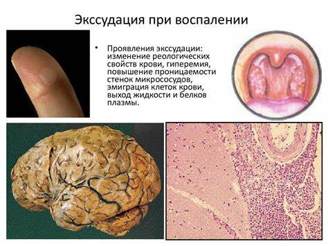 Острое воспаление холецистита диета Воспаление. Острое воспаление - online presentation Воспаление. Острое воспаление - online presentation Острое воспаление холецистита диета