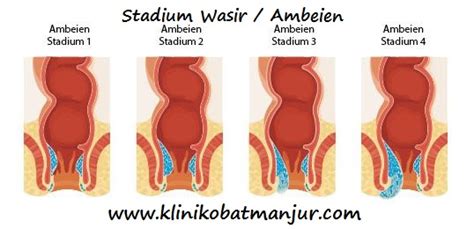 Namun sebenarnya pembuluh darah tidak hanya bisa pecah di bagian otak, lho! cara mengobati ambeien secara alami dan tradisional ...