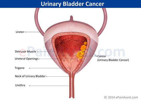 The patient may also suffer from constant pain in the side, or experience fevers, weight loss; Urinary Bladder Cancer|Types|Symptoms|Stages|Treatment-TUR ...