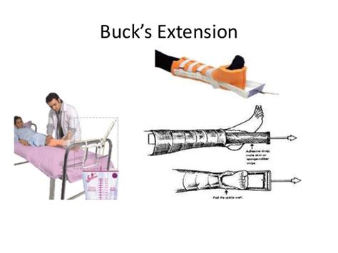 This is an indication for buck's traction. Traction