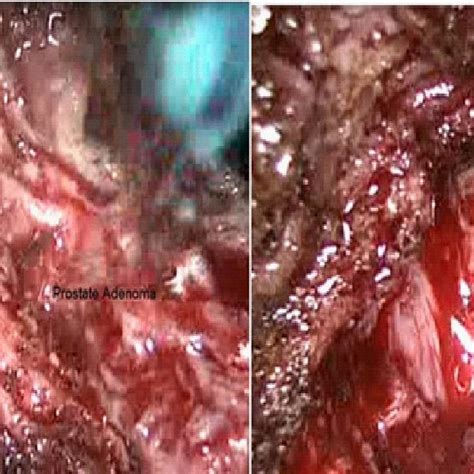 Pancreatitis, cancer of the head of the pancreas pyelonephritis (sensitivity in the costal vertebral corner), renal colic. Diego CARRION MONSALVE | Facultativo Especialista Adjunto ...