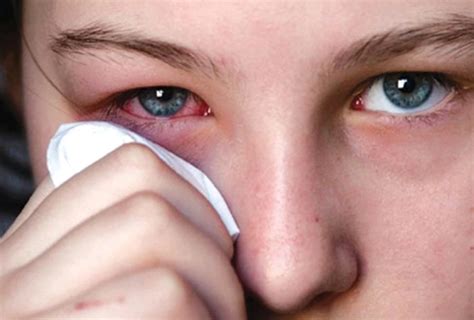 Hilangkan Sakit Mata Disebabkan Alergi Atau Bakteria Dengan 10 Cara ...