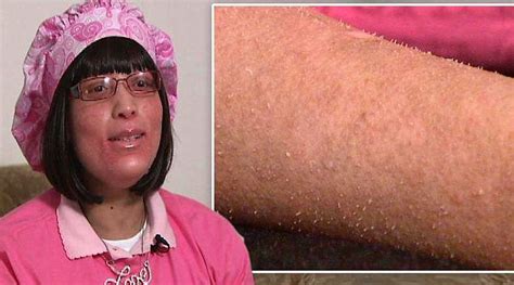 You have hair follicles just about everywhere except your lips, your palms, and the soles of your folliculitis can make these hair follicles red and swollen. Une maladie inconnue lui fait pousser des ongles sur le ...