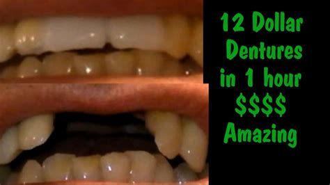 Sent from and sold by the smiling company. Cheap Dentures 12 dollar dentures (bridge) in about 1 hour (DIY) - YouTube