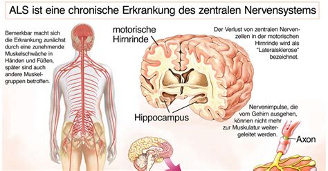 What is amyotrophic lateral sclerosis? ALS - Amyothrophe Lateralsklerose | journalmed.de