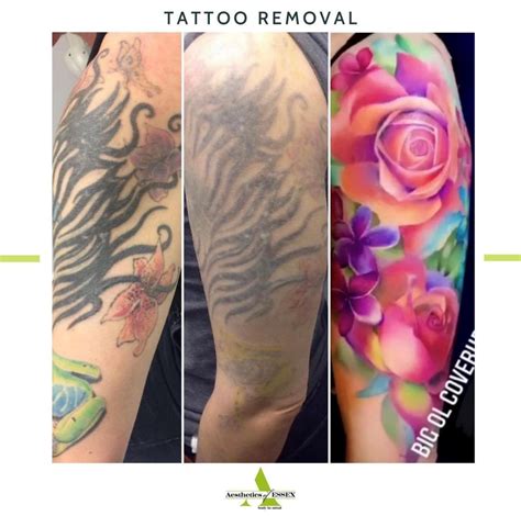 Medicaid coverage for tattoo removal is the same as it is for medicare. Picosure Tattoo Removal Essex - Aesthetics of Essex