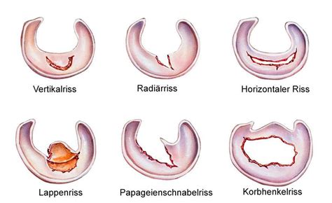 Der innenmeniskusriss ist deutlich häufiger als ein außenmeniscusriss und entsteht meist auf dem boden einer degenerativen vorschädigung. Meniskusriss: Symptome, Ursachen, Behandlung | www.gelenk ...