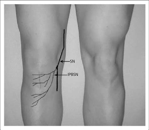 Knee joint tendonitis often follows injuries or overuse of the tendon and muscles following repeated movements caused by muscle contraction resulting in pull of the tendon. A drawing of the SN and the IPBSN on a right knee after ...