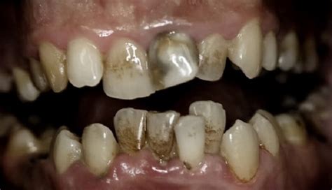 It's not that these individuals don't want to fix their teeth; Rotten Teeth and Tooth Decay - Headgear Braces