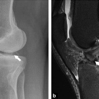 Avulsion of the femoral attachment of medial collateral ...