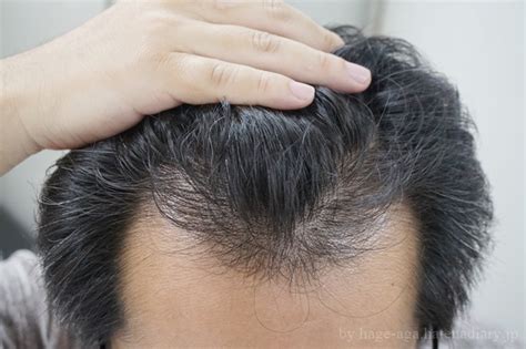 ベストオブ 天然 パーマ はげ - 画像ブログ