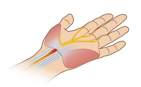 Maybe you would like to learn more about one of these? PUC | Schmerzen nach Karpaltunnel OP | Abklärung mittels ...