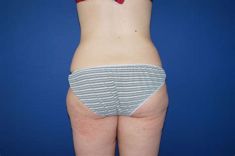 See 375,371 traveler reviews and photos of marseille tourist attractions. Photo avant-apres abdominoplastie, lifting du ventre
