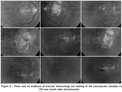 We did not find results for: avastin injection