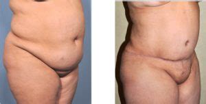 Check spelling or type a new query. The Differences Between a Cosmetic Abdominoplasty and a ...