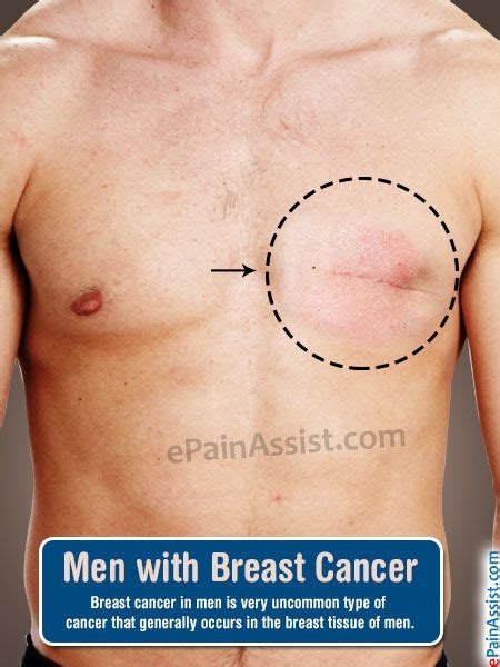 Unexpected weight loss and a loss of appetite Brest Cancer In Men - Cancer News Update