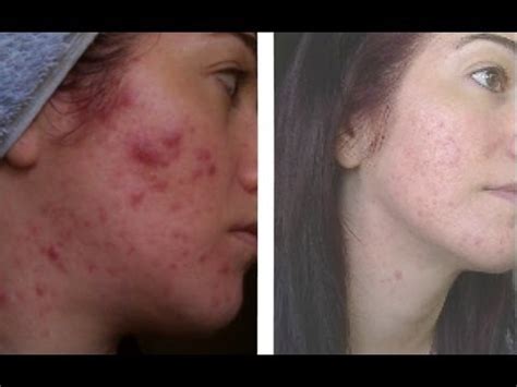 Exposed skin care acne treatment serum review. UPDATED Exposed Skin Care Review - 1 Year on! My Acne ...