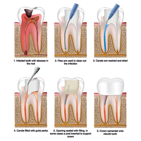 A root canal is a procedure that treats a tooth's nerve. Root Canal Specialist near you | Root canal from $699