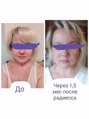 Как убрать отек с живота после операции