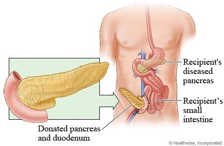 Pancreatic cancer — overview covers symptoms, risk factors, prevention, diagnosis, surgery, chemotherapy and other treatment for cancer of the pancreas. زراعة خلايا البنكرياس | صيدلية الملاك