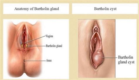 Berikut penyebab adanya benjolan di leher atau bengkak sebelah kanan, kiri, belakang, bawah telinga dan dagu pada anak. Badan Sihat Hati Ceria: Tanda- Tanda Bartholin Cyst dan ...