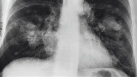 34+ listes de stomach ribs lungs picture! xray-rib-cage-stomach - The Cooler Box