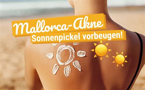 «wie lange sie andauert, ist individuell. Mallorca-Akne: Wie Du Sonnenpickel vorbeugen kannst! - The ...