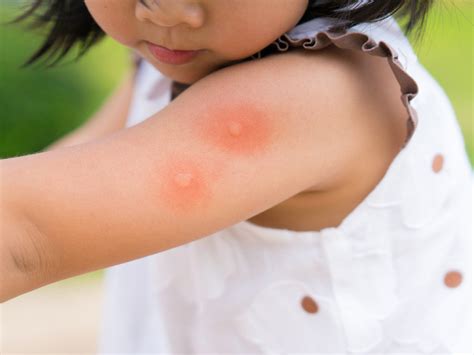 But 2,000 or more people a year get bitten. Dengue in Children - Signs, Diagnosis & Treatment