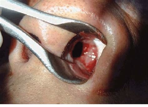 Some people with a perforated nasal septum won't experience any symptoms, however, more severe perforations can result in more severe and debilitating symptoms. Nasal septal perforation with marginal brownish crusting ...