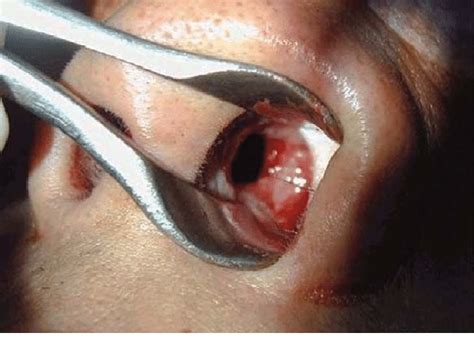 Surgery to correct nasal septum perforation is very serious and must be conducted in a hospital environment. Nasal septal perforation with marginal brownish crusting ...