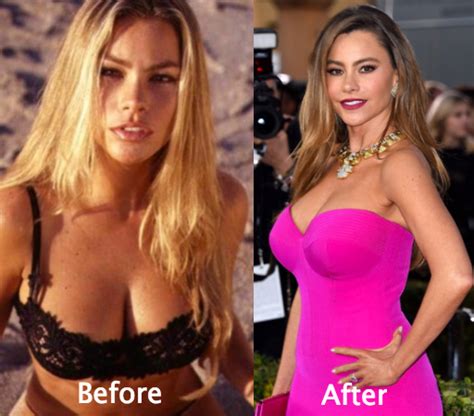 Nov 06, 2020 · options for plastic surgery financing. Sofia Vergara Plastic Surgery Before and After Photos