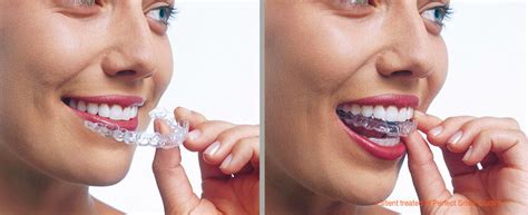 Different types of braces are available, from fixed braces to sets of removable aligners. How Long Does Invisalign Treatment Take?