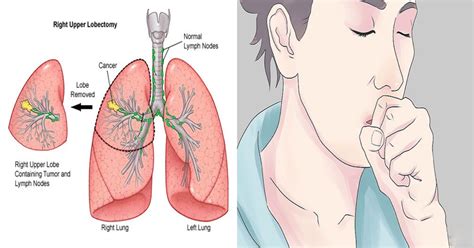 Lung cancer is the second most common form of cancer for both men and women, but there are major differences between outlook and treatment. 11 Warning Signs of Lung Cancer | Health by Sea