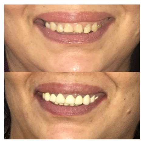 We did not find results for: Before and After - Zenith Dental Care