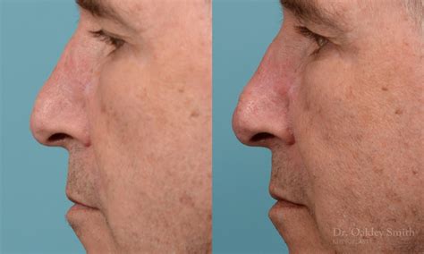 We did not find results for: Scar removal rhinoplasty