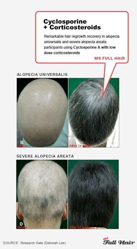 Corticosteroid, betamethasone and hair loss about betamethasone: loss of hair prevention female natural home remedy, All ...