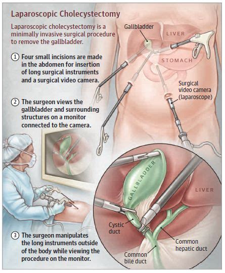 Sometimes the gallbladder fails to work properly, and can become filled with gallstones. Cholecystectomy (Gall Bladder Removal) - In this week's ...