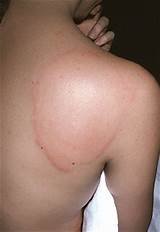 Hives rashes usually settle down within a few minutes to a few days. Eastside Family Health Center: The Rash of Hives