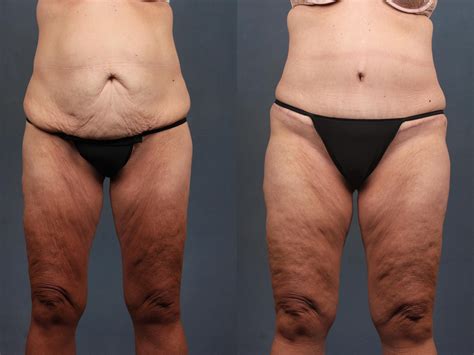 All tummy tuck before and after photos are of patients who have given consent for their images to be published on this site. Tummy Tuck Before & After Photo Gallery | Louisville, KY ...